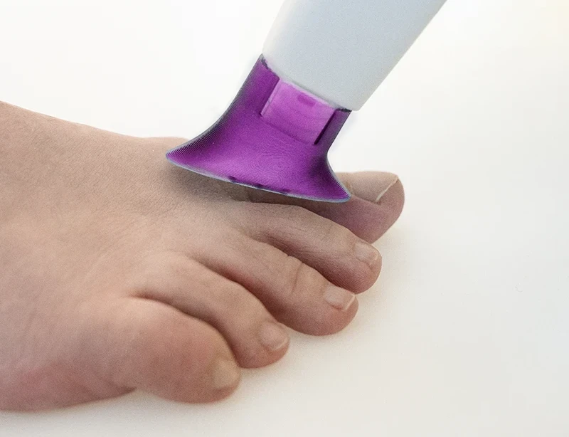 ViroCAP Behandlung Nagelpilz